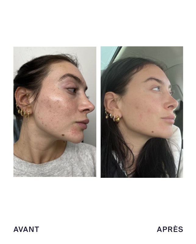 Close up shot of MONAT Market Partner's face with acne. Close up shot of MONAT Market Partner with cleared skin after using MONAT BE CLARIFIED™ Line.