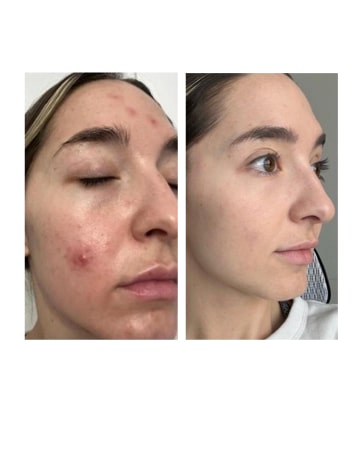 Close up shot of MONAT Market Partner's face with acne. Close up shot of MONAT Market Partner with cleared skin after using MONAT BE CLARIFIED™ Line.
