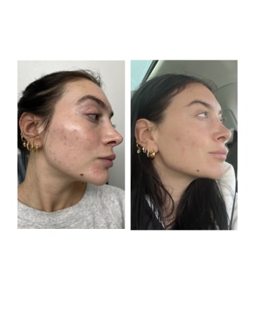 Close up shot of brunette MONAT Market Partner's face with acne. Close up shot of brunette MONAT Market Partner with cleared skin after using MONAT BE CLARIFIED™ Line.